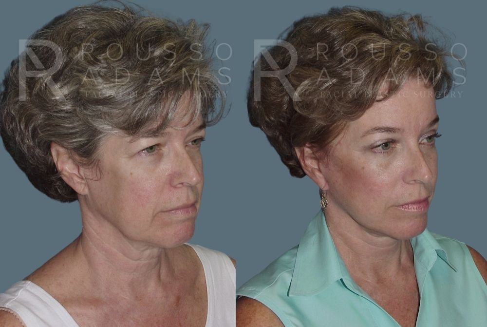 Facelift Before & After Gallery - Patient 147375031 - Image 1