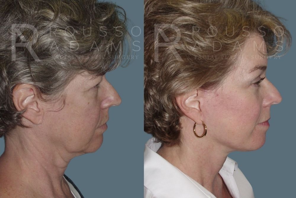Facelift - Dr. Rousso Before & After Gallery - Patient 147375031 - Image 2