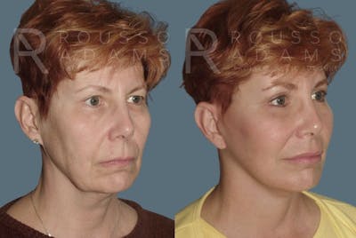 Facelift Before & After Gallery - Patient 147375032 - Image 1