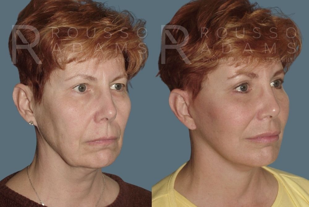 Facelift <span class=small>By Dr. Daniel Rousso</span> Before & After Gallery - Patient 147375032 - Image 1