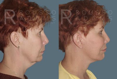 Facelift <span class=small>By Dr. Daniel Rousso</span> Before & After Gallery - Patient 147375032 - Image 2