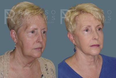 Facelift Before & After Gallery - Patient 147375037 - Image 1