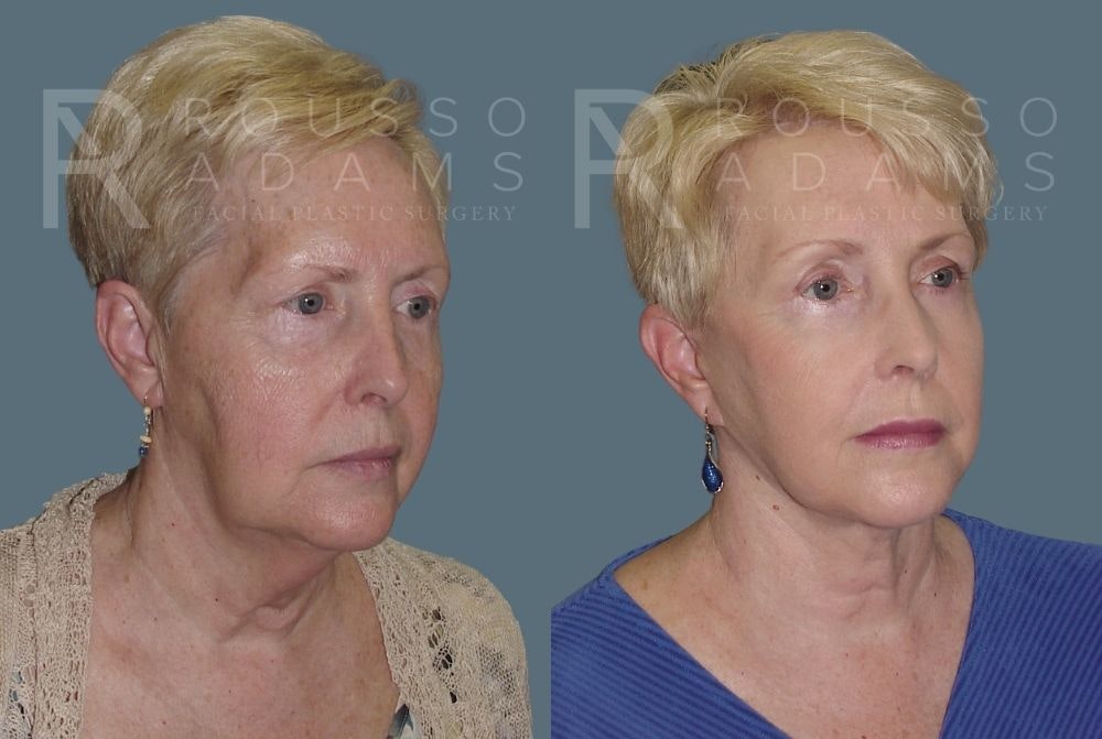 Facelift <span class=small>By Dr. Daniel Rousso</span> Before & After Gallery - Patient 147375037 - Image 1