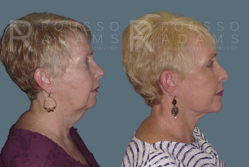 Facelift - Dr. Rousso Before & After Gallery - Patient 147375037 - Image 2