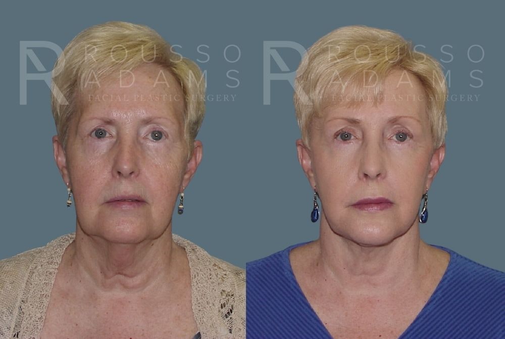 Facelift - Dr. Rousso Before & After Gallery - Patient 147375037 - Image 3