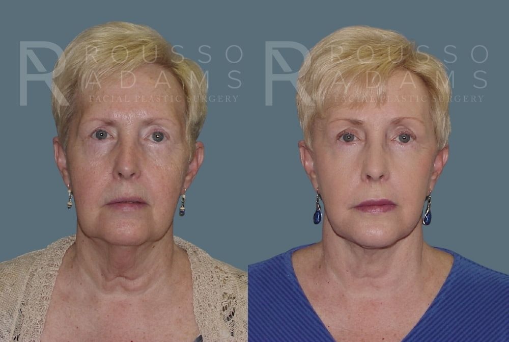 Facelift <span class=small>By Dr. Daniel Rousso</span> Before & After Gallery - Patient 147375037 - Image 3