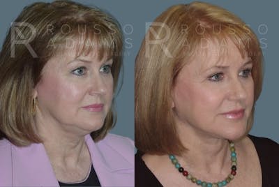 Facelift <span class=small>By Dr. Daniel Rousso</span> Before & After Gallery - Patient 147375038 - Image 1