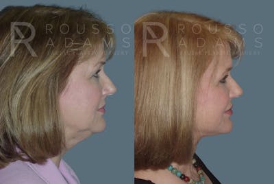 Facelift <span class=small>By Dr. Daniel Rousso</span> Before & After Gallery - Patient 147375038 - Image 2