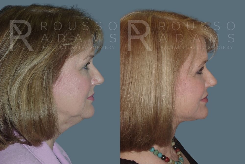 Facelift <span class=small>By Dr. Daniel Rousso</span> Before & After Gallery - Patient 147375038 - Image 2