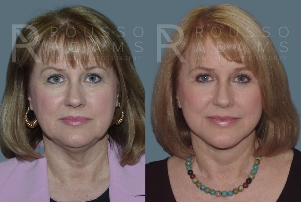 Facelift <span class=small>By Dr. Daniel Rousso</span> Before & After Gallery - Patient 147375038 - Image 3