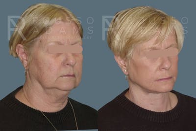 Facelift Before & After Gallery - Patient 147375040 - Image 1