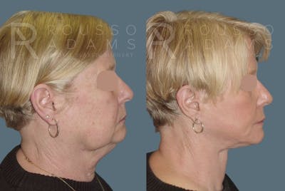 Facelift <span class=small>By Dr. Daniel Rousso</span> Before & After Gallery - Patient 147375040 - Image 2