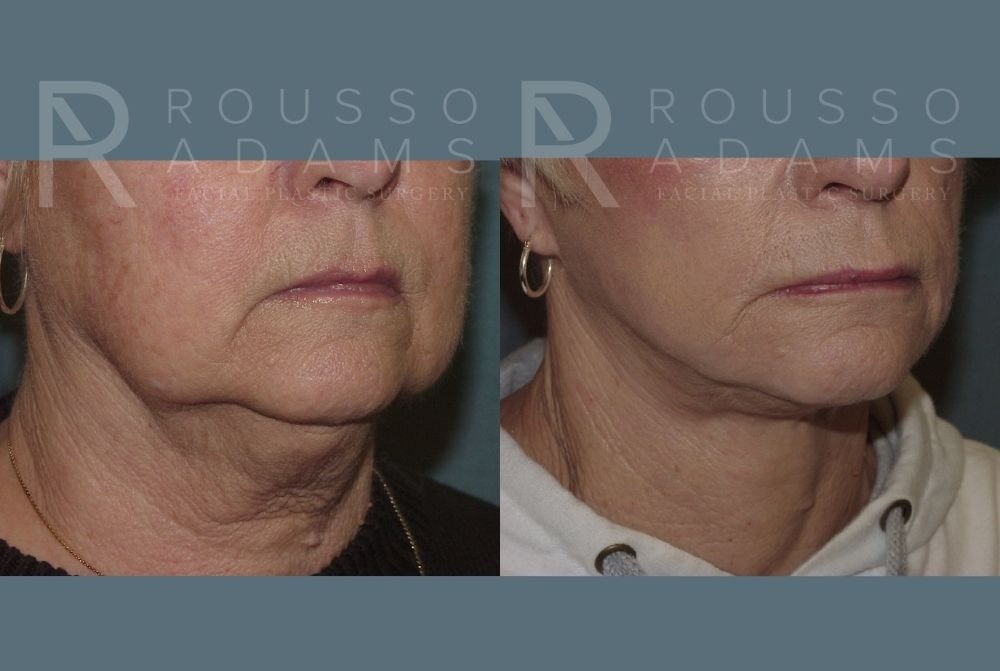 Facelift <span class=small>By Dr. Daniel Rousso</span> Before & After Gallery - Patient 147375040 - Image 3