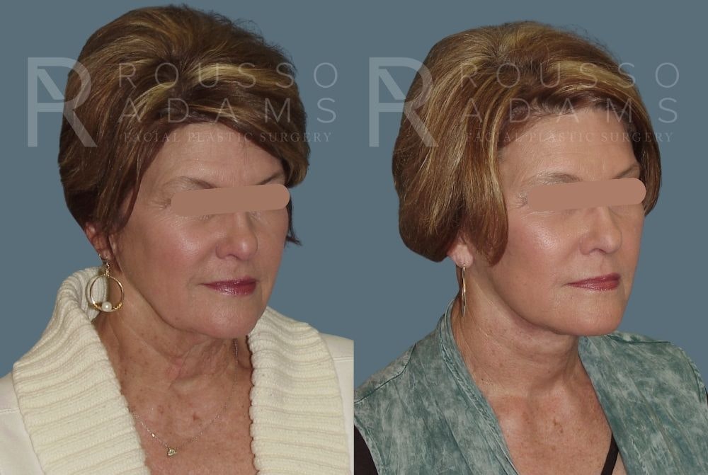 Facelift - Dr. Rousso Before & After Gallery - Patient 147375050 - Image 1