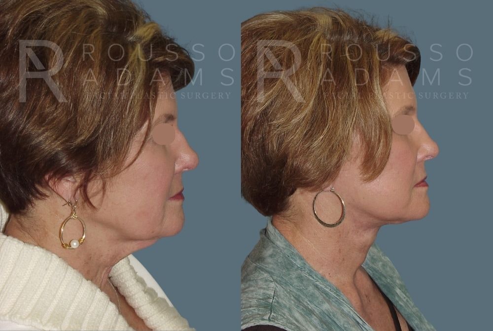 Facelift - Dr. Rousso Before & After Gallery - Patient 147375050 - Image 2