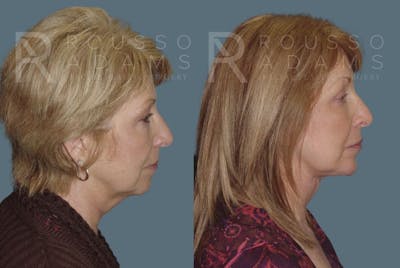 Facelift <span class=small>By Dr. Daniel Rousso</span> Before & After Gallery - Patient 147375051 - Image 2