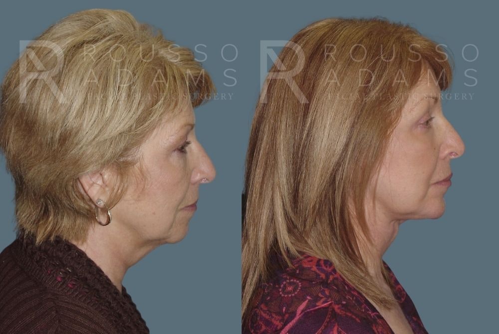 Facelift <span class=small>By Dr. Daniel Rousso</span> Before & After Gallery - Patient 147375051 - Image 2