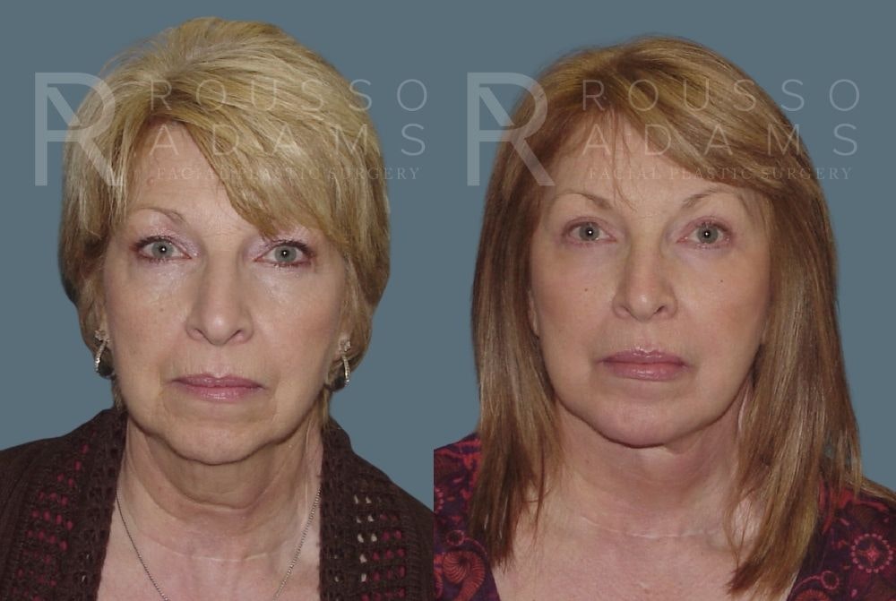 Facelift <span class=small>By Dr. Daniel Rousso</span> Before & After Gallery - Patient 147375051 - Image 3