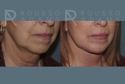 Facelift - Dr. Rousso Before & After Gallery - Patient 147375051 - Image 4