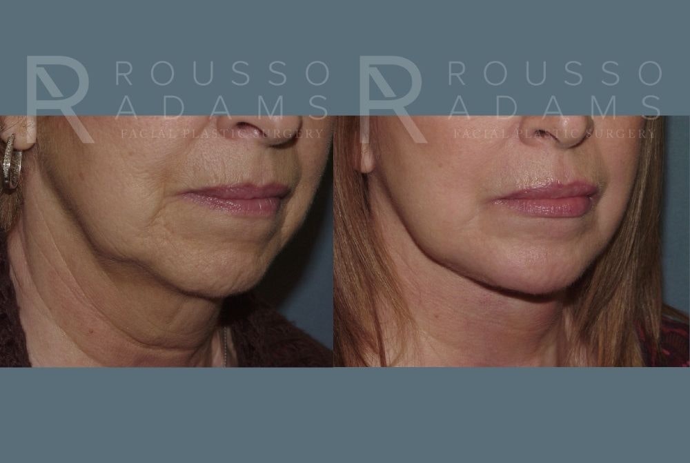 Facelift <span class=small>By Dr. Daniel Rousso</span> Before & After Gallery - Patient 147375051 - Image 4
