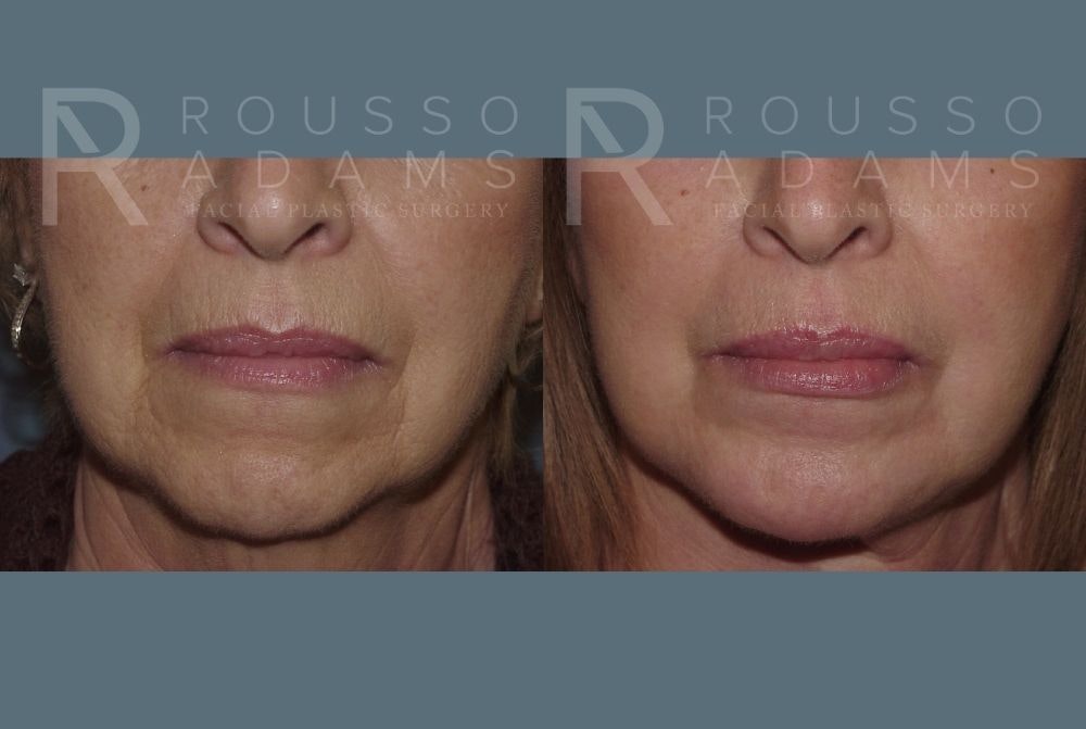 Facelift <span class=small>By Dr. Daniel Rousso</span> Before & After Gallery - Patient 147375051 - Image 5