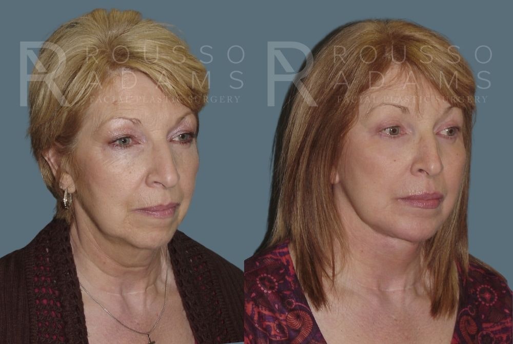 Facelift - Dr. Rousso Before & After Gallery - Patient 147375051 - Image 1