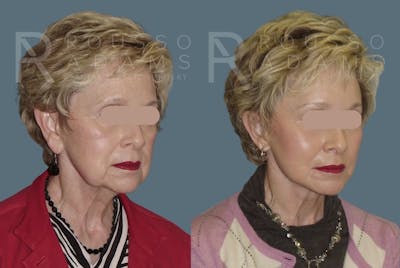 Facelift - Dr. Rousso Before & After Gallery - Patient 147375061 - Image 1