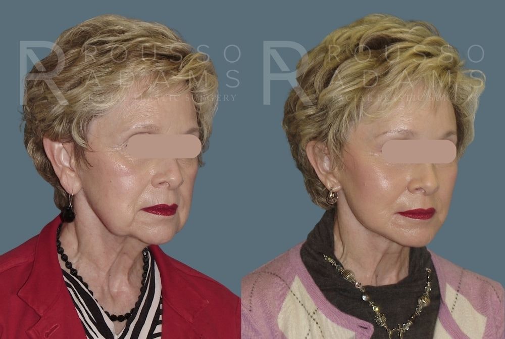Facelift <span class=small>By Dr. Daniel Rousso</span> Before & After Gallery - Patient 147375061 - Image 1