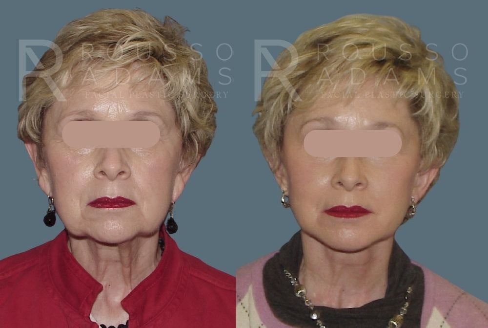 Facelift <span class=small>By Dr. Daniel Rousso</span> Before & After Gallery - Patient 147375061 - Image 2