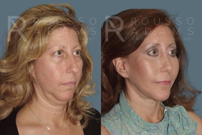 Facelift <span class=small>By Dr. Daniel Rousso</span> Before & After Gallery - Patient 147375062 - Image 1