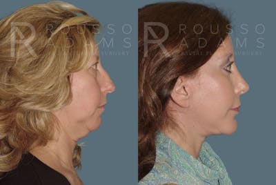 Facelift <span class=small>By Dr. Daniel Rousso</span> Before & After Gallery - Patient 147375062 - Image 2