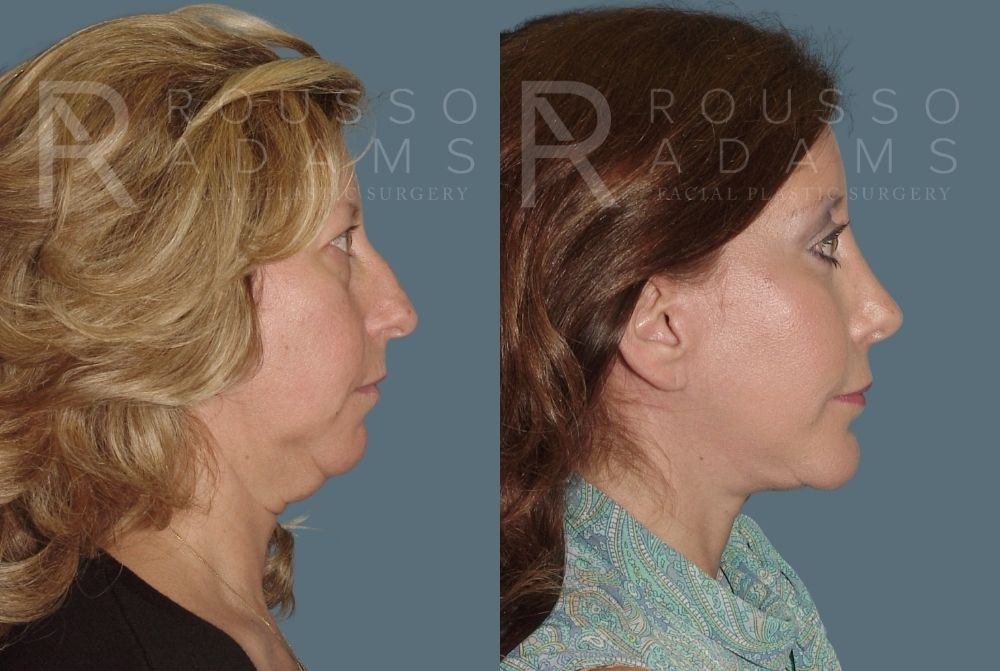 Facelift <span class=small>By Dr. Daniel Rousso</span> Before & After Gallery - Patient 147375062 - Image 2