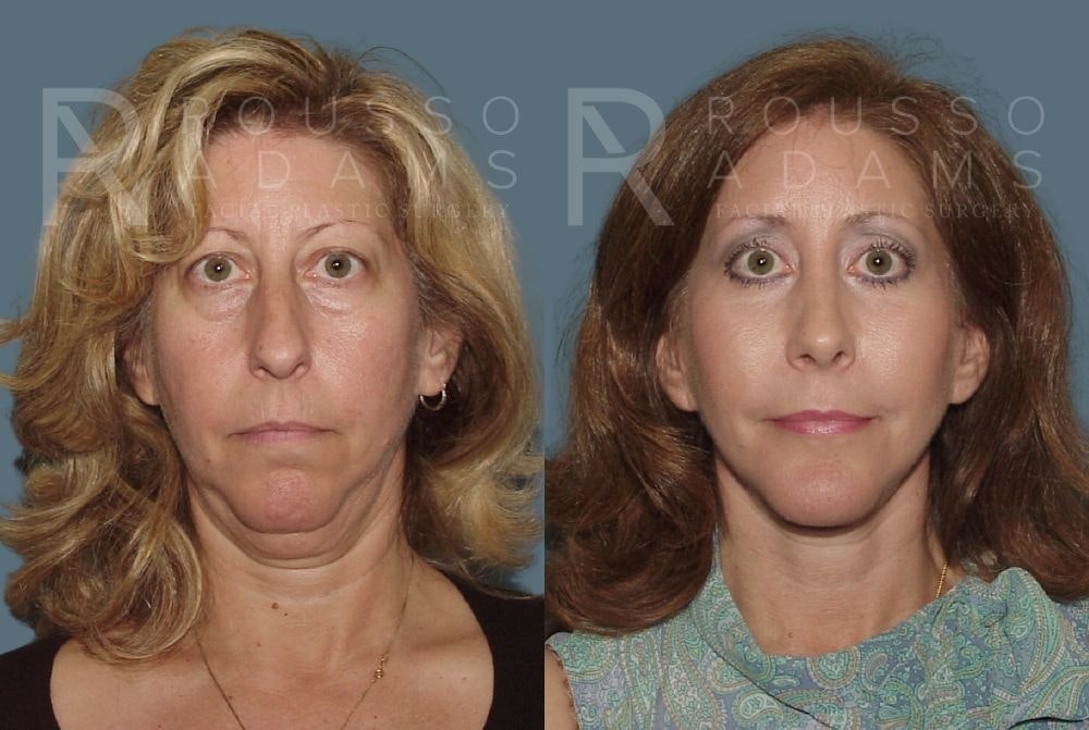 Facelift <span class=small>By Dr. Daniel Rousso</span> Before & After Gallery - Patient 147375062 - Image 3
