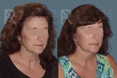 Facelift Before & After Gallery - Patient 147375103 - Image 1