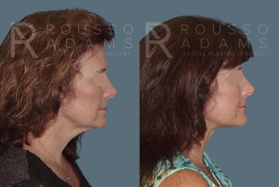 Facelift - Dr. Rousso Before & After Gallery - Patient 147375103 - Image 2