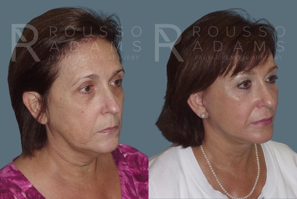 Facelift - Dr. Rousso Before & After Gallery - Patient 147375104 - Image 1