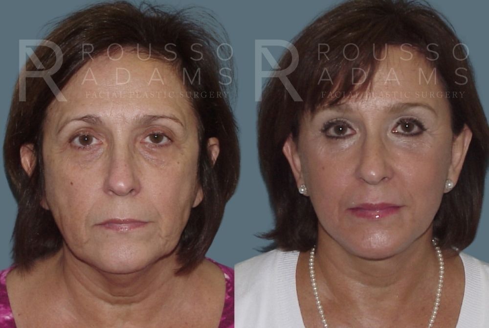 Facelift - Dr. Rousso Before & After Gallery - Patient 147375104 - Image 2