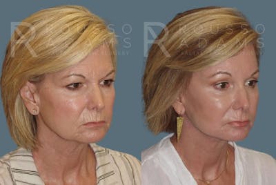Facelift <span class=small>By Dr. Daniel Rousso</span> Before & After Gallery - Patient 147375105 - Image 1