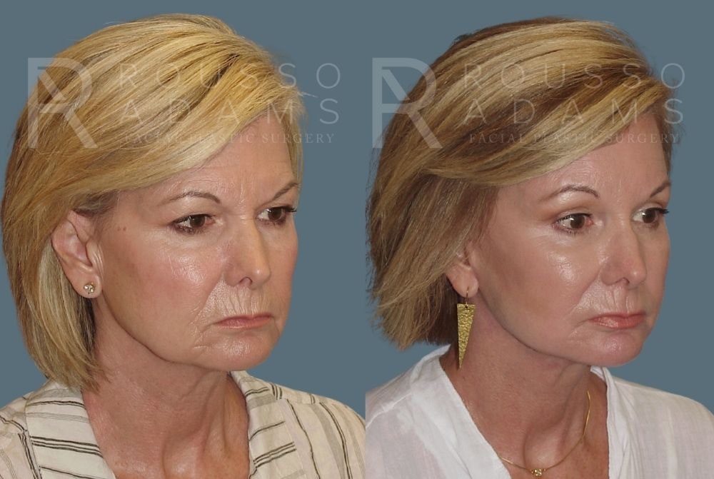 Facelift Before & After Gallery - Patient 147375105 - Image 1