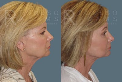 Facelift - Dr. Rousso Before & After Gallery - Patient 147375105 - Image 2