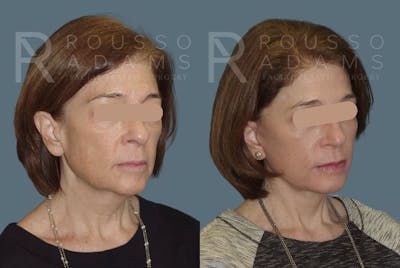 Facelift Before & After Gallery - Patient 147375106 - Image 1