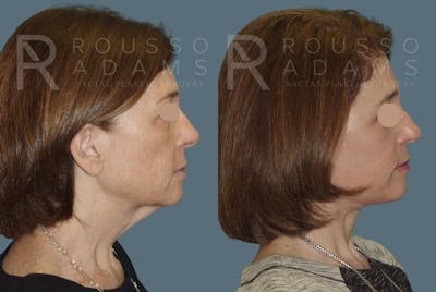 Facelift - Dr. Rousso Before & After Gallery - Patient 147375106 - Image 2