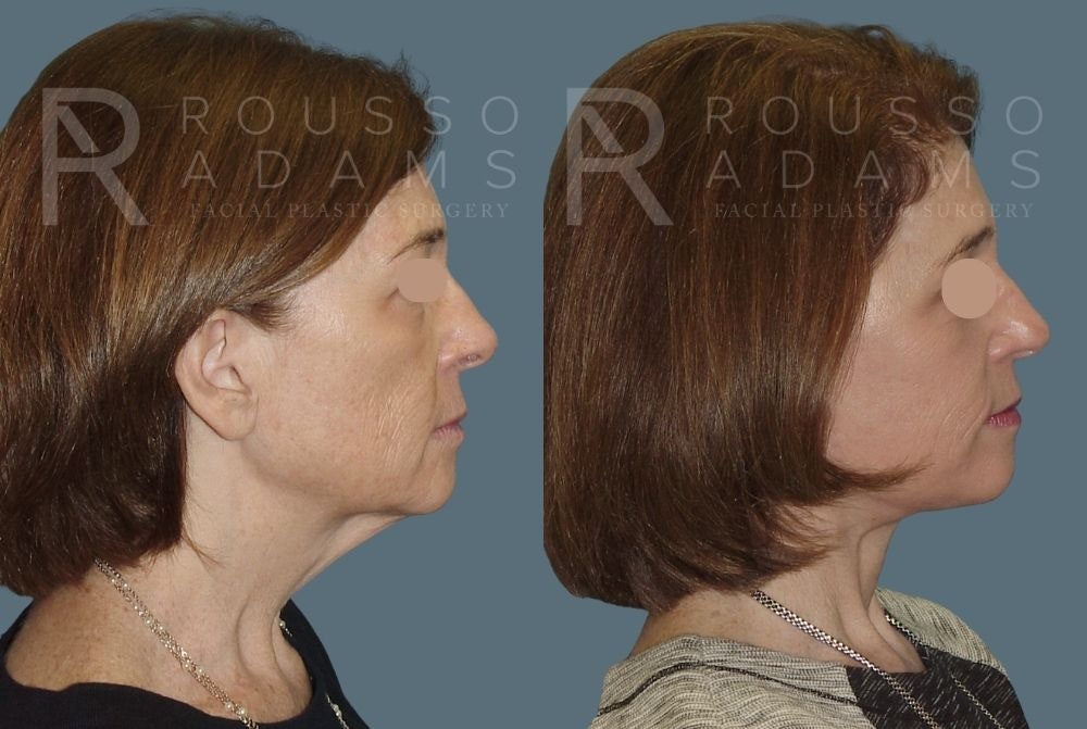 Facelift Before & After Gallery - Patient 147375106 - Image 2