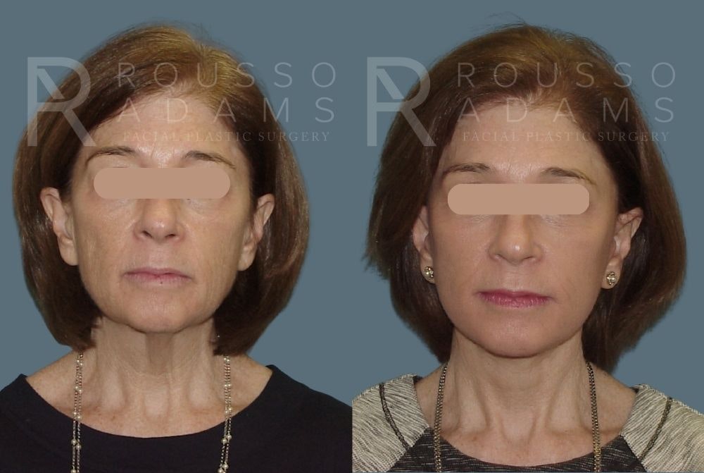 Facelift - Dr. Rousso Before & After Gallery - Patient 147375106 - Image 3