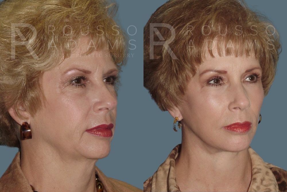 Facelift Before & After Gallery - Patient 147375107 - Image 1