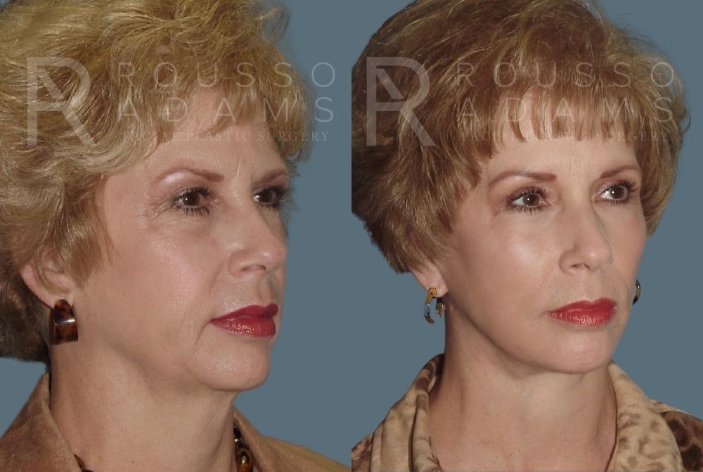 Facelift <span class=small>By Dr. Daniel Rousso</span> Before & After Gallery - Patient 147375107 - Image 1