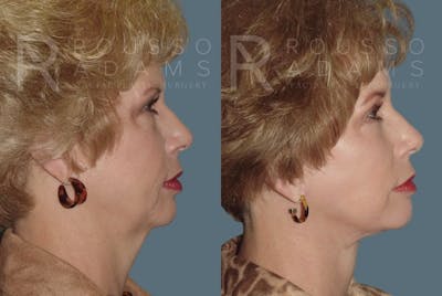 Facelift <span class=small>By Dr. Daniel Rousso</span> Before & After Gallery - Patient 147375107 - Image 2
