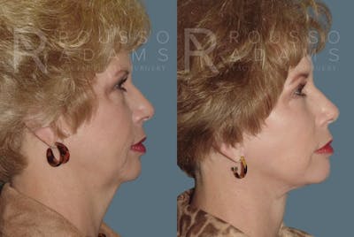 Facelift Before & After Gallery - Patient 147375107 - Image 2
