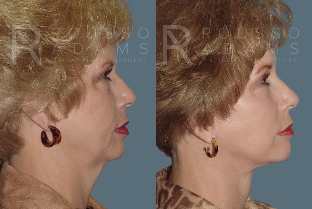 Facelift - Dr. Rousso Before & After Gallery - Patient 147375107 - Image 2