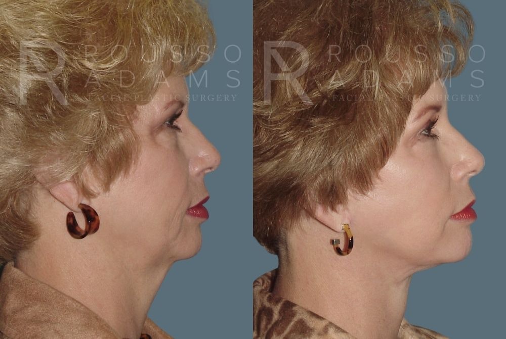 Facelift <span class=small>By Dr. Daniel Rousso</span> Before & After Gallery - Patient 147375107 - Image 2